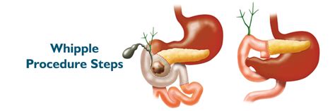 Whipple Procedure Steps