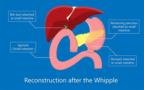 Whipple Surgery