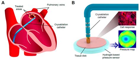 Working Mechanism Of Ablation Therapy
