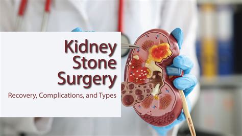 Working Mechanisms of Kidney Stone Surgery