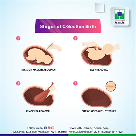 Working Mechanisms of C-Section Recovery