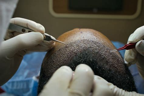 Working Mechanisms of Hair Replacement Surgery