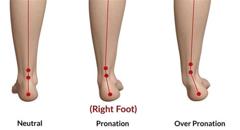 Abnormal Foot Pronation