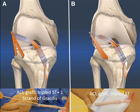 acl recovery overview