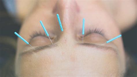 Acupressure and Acupuncture for Contractions
