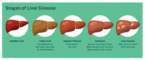 Advanced Liver Disease and Liver Transplantation