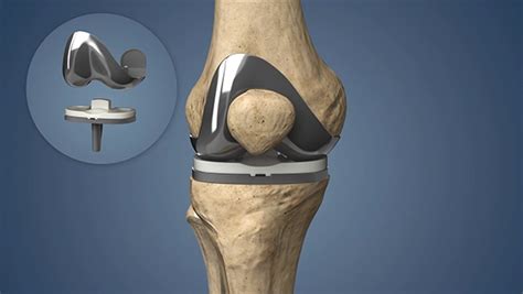 Advancements in Knee Transplant Technology