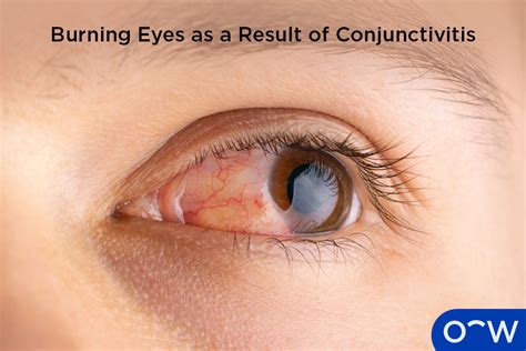 Alleviate Burning Eyes