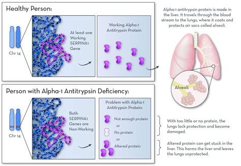 Alpha 1 Antitrypsin Deficiency