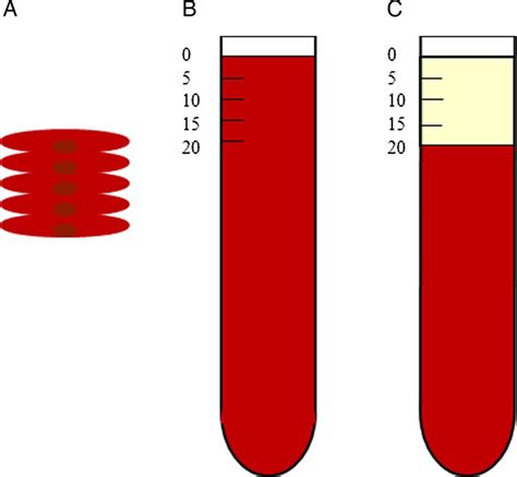 Alternatives to Sed Rate Blood Test