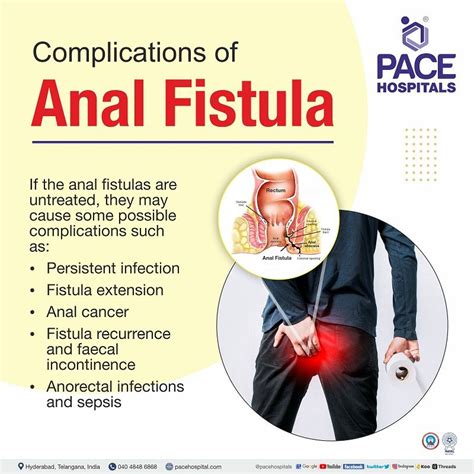 Anal Cyst Complications