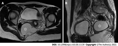 Anal Cyst Conclusion