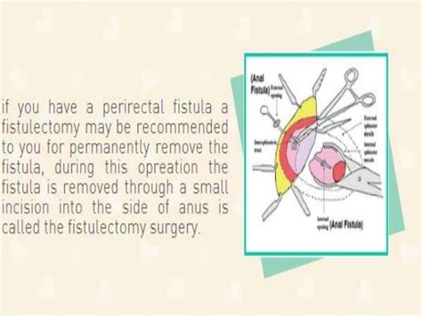 Anal Cyst Treatment