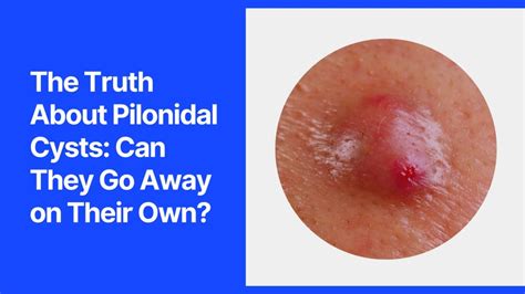 anal cysts