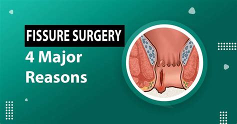 Anal Fissure Surgery