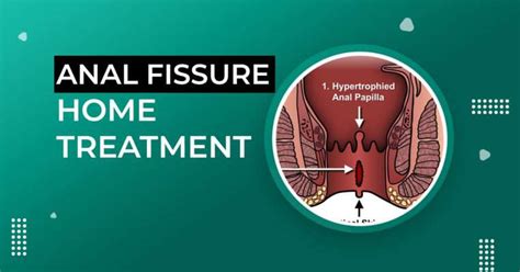Anal Fissure Treatment