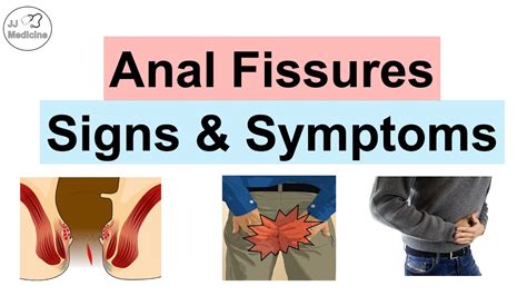 Understanding Anal Fissures