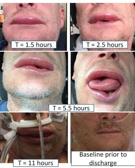 Angioedema and Lisinopril