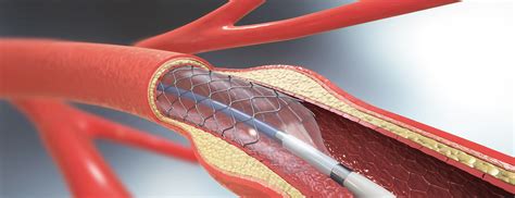 Angioplasty and Stents