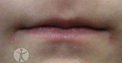 Angular Cheilitis in Different Age Groups