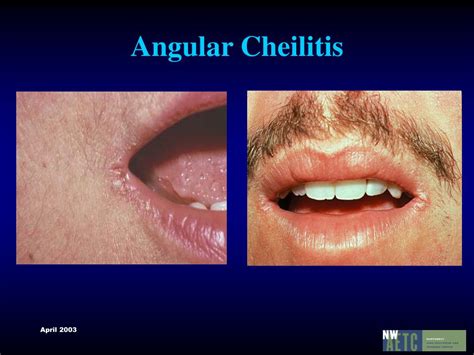 Angular Cheilitis and Systemic Diseases