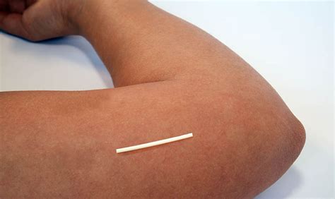 anti-pregnancy arm implant