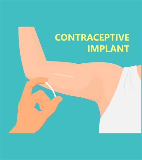 anti-pregnancy arm implant impact