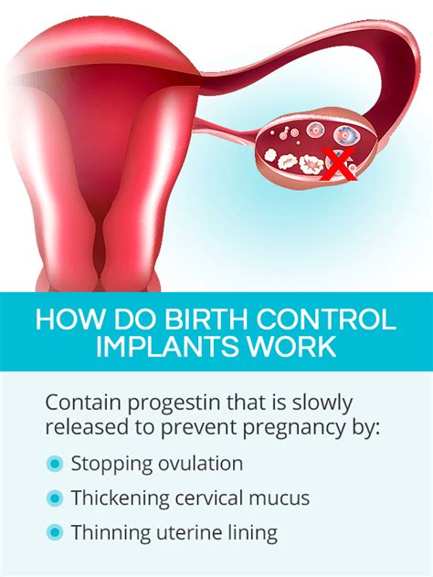 anti-pregnancy arm implant statistics
