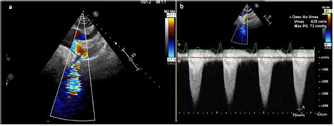 aortic diagnosis