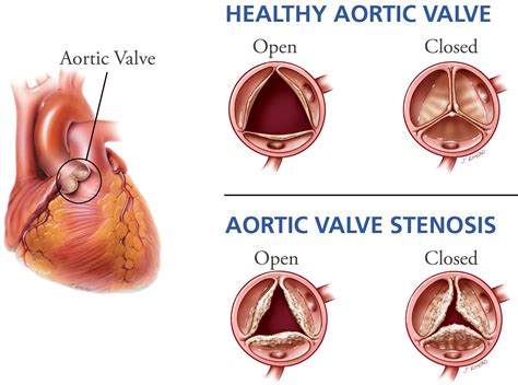 aortic diseases