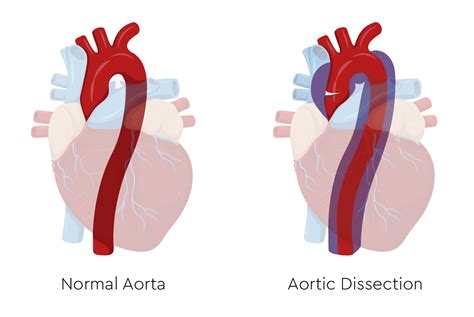 aortic health