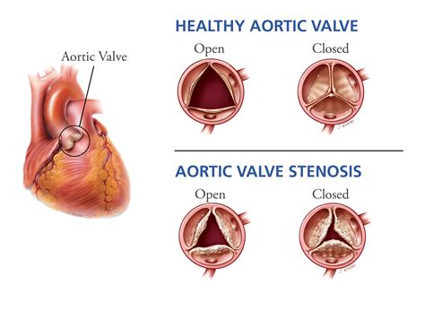 aortic stenosis
