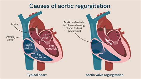 Aortic Valve Regurgitation Causes