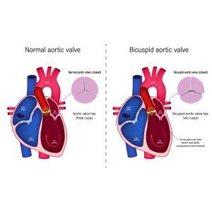 Aortic Valve Regurgitation Symptoms