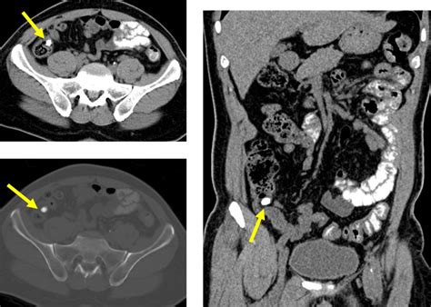 appendectomy