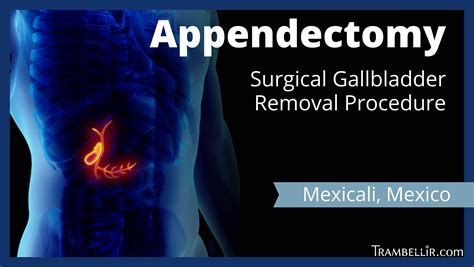 appendectomy procedure