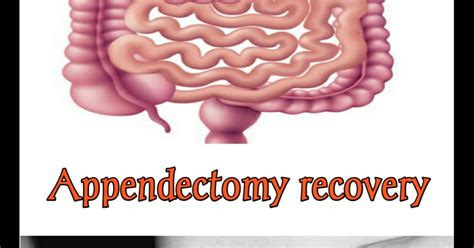 appendectomy recovery process