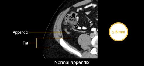 appendicitis