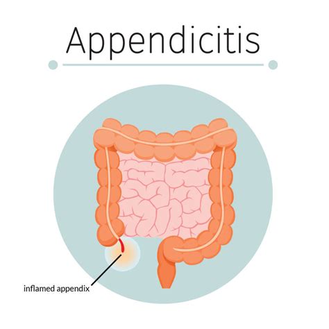 appendicitis illustration