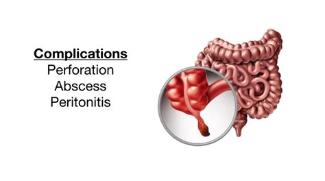 appendicitis complications illustration