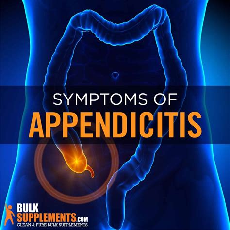 appendicitis faqs illustration