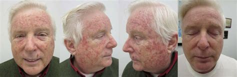Applications of Fluorouracil Cream