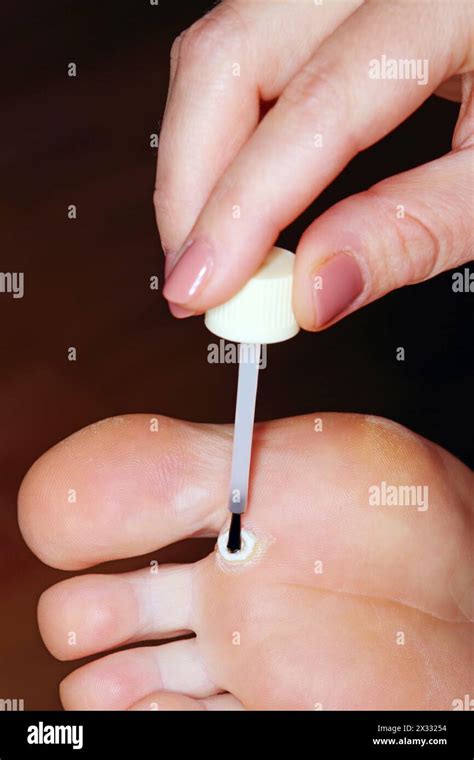 applying salicylic acid for warts treatment