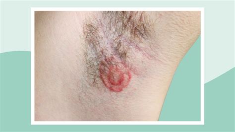 armpit fungal infection conclusion