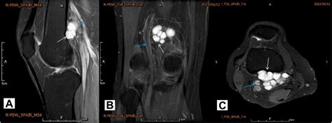 arthroscopic ganglion cyst removal