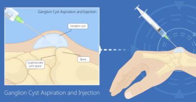 aspiration and surgery for ganglion cysts