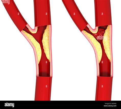 Atherosclerosis of Abdominal Aorta