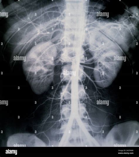Atherosclerosis and Aortic Aneurysms
