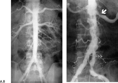 Atherosclerosis and Aortic Dissection