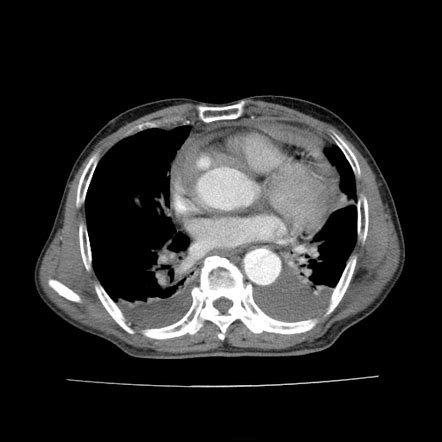 Atherosclerosis and Aortic Rupture